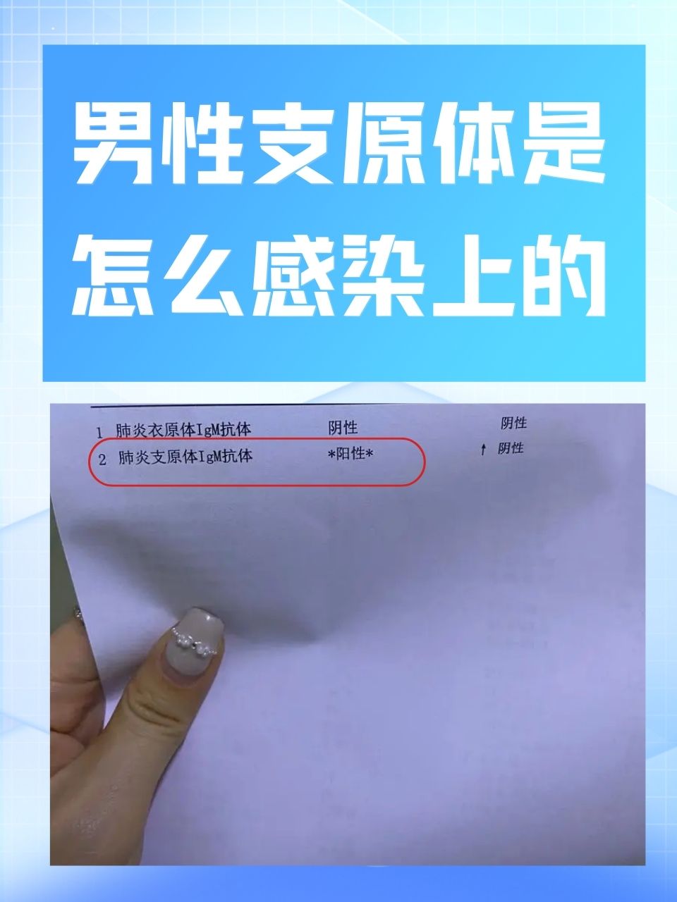 男性支原体是怎么感染上的  在男性的健康话题中,支原体感染是一个不