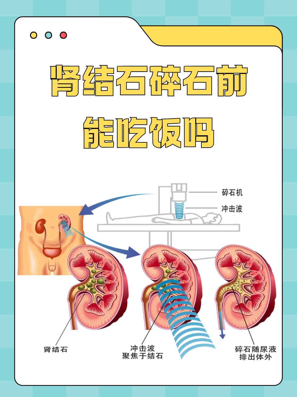 肾结石超声波碎石图片