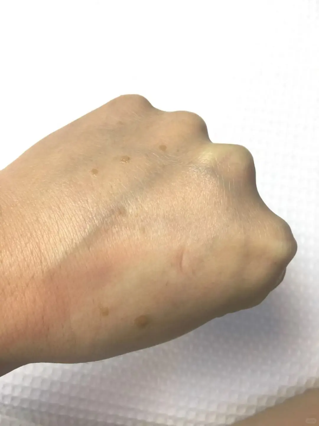 疣体是由人乳头瘤病毒(hpv)感染引起的皮肤表面赘生物