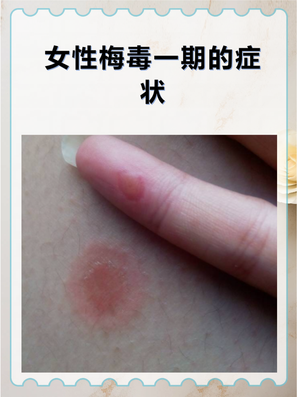 女性梅毒一期症状往往容易被忽视,但早期发现对