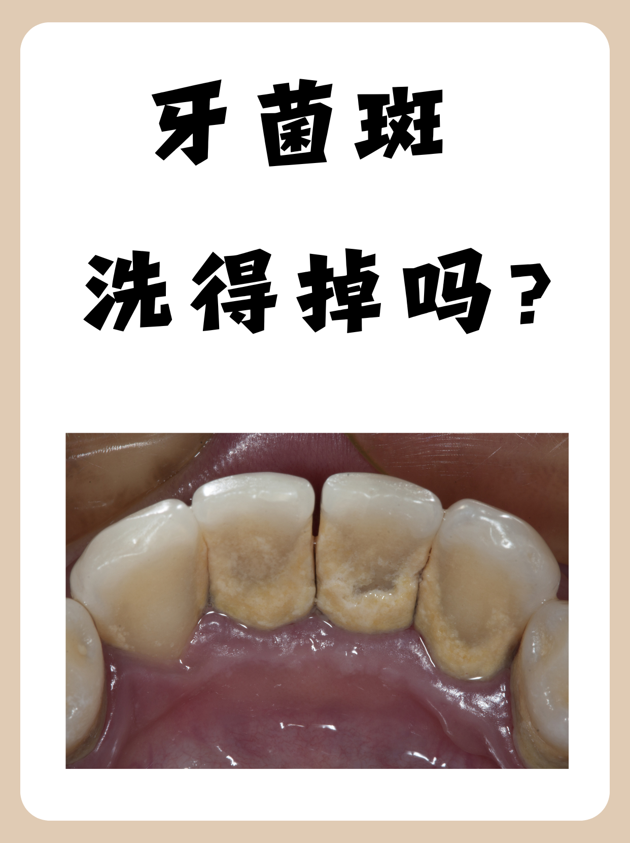 牙菌斑洗得掉吗?