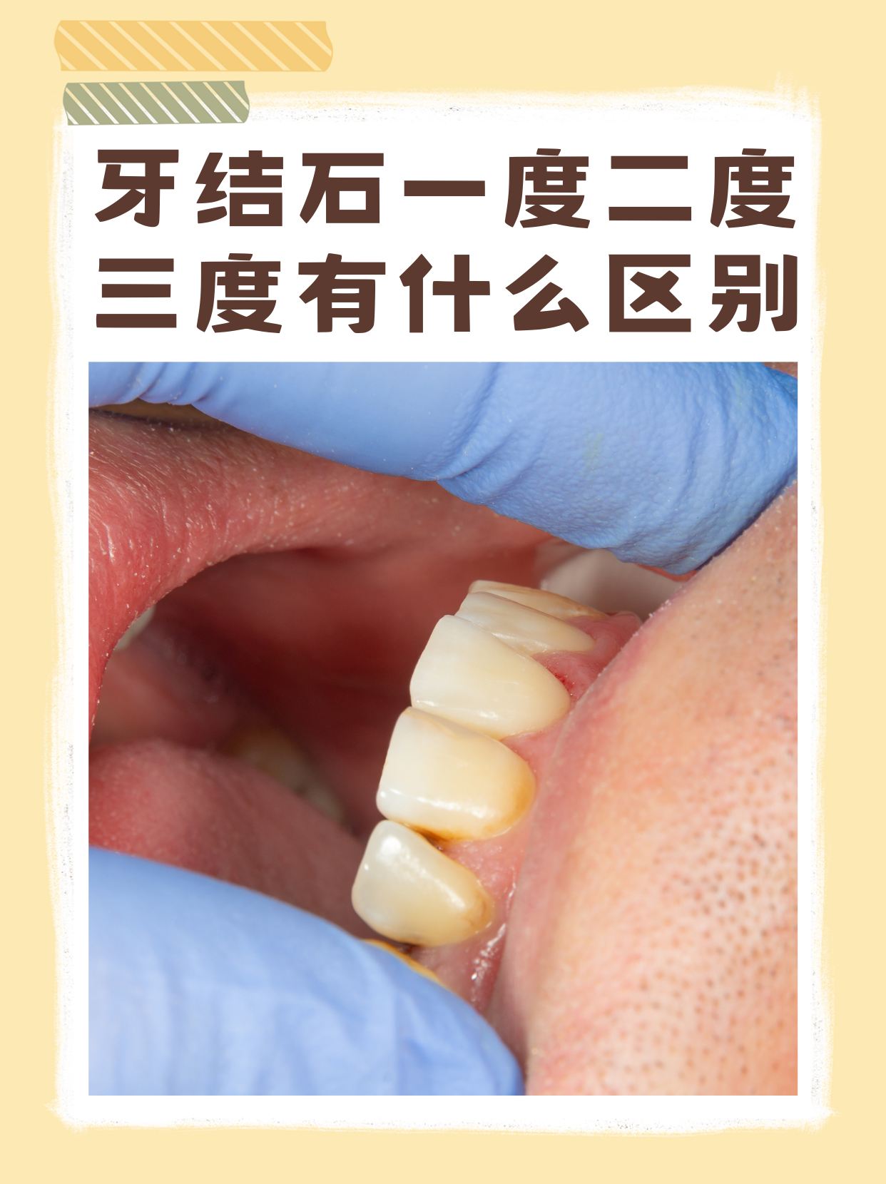 牙结石是由牙菌斑和软垢钙化而成的