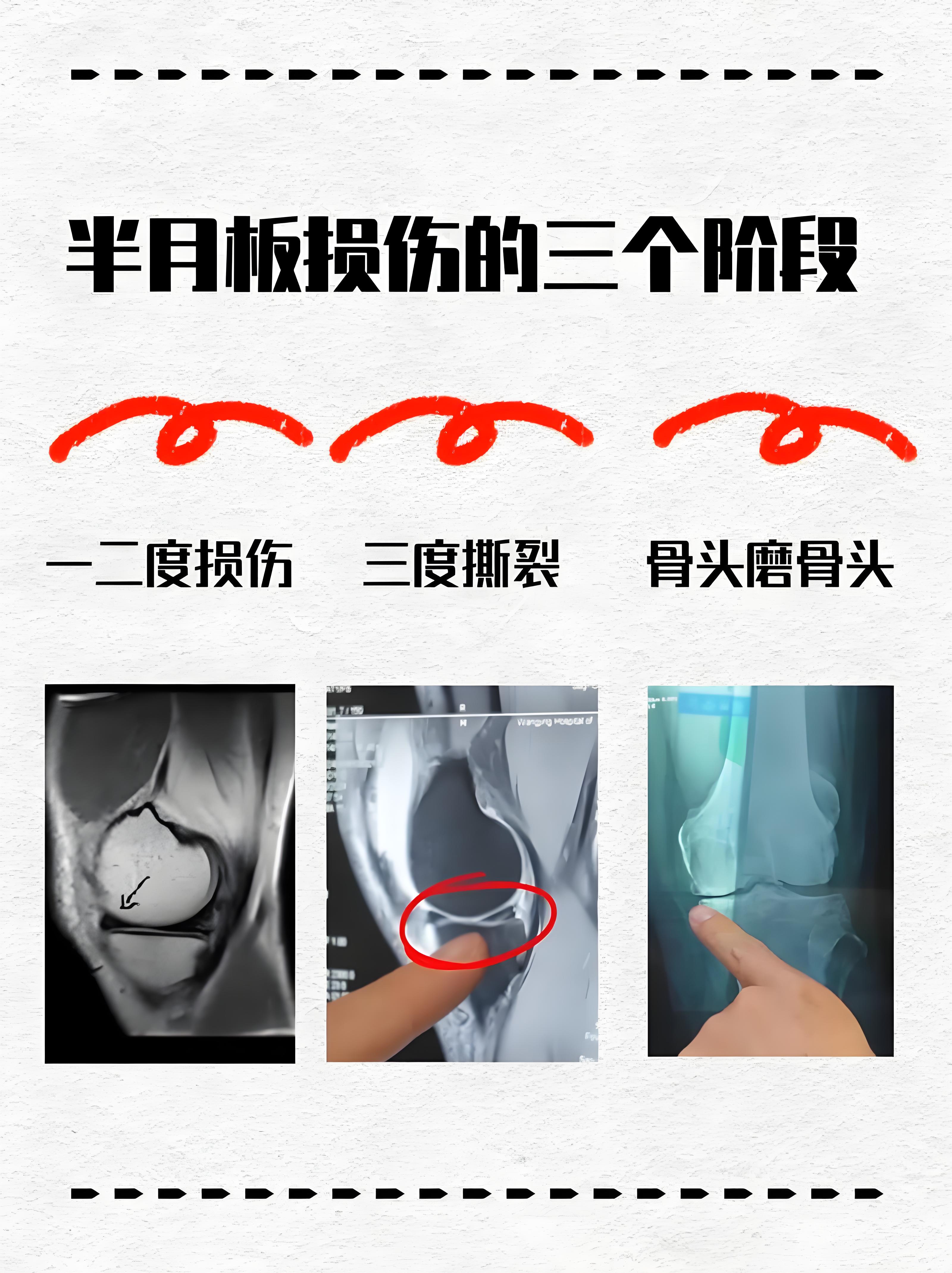 第一个滑膜炎,第二个半月板损伤