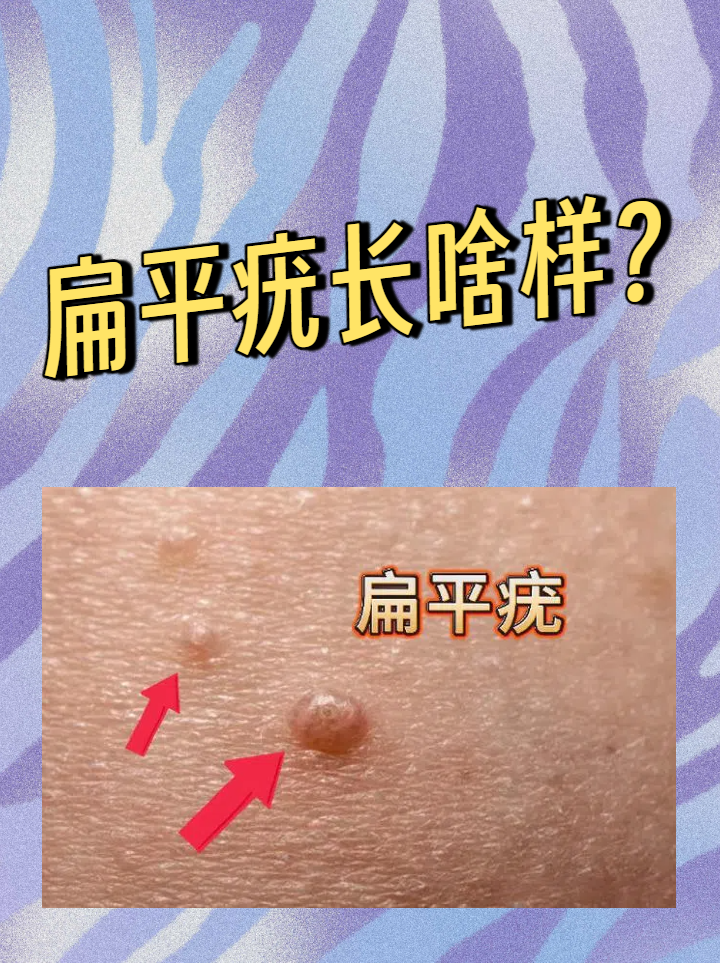 扁平疣长啥样?