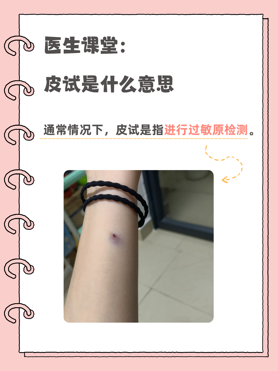 为什么打破伤风针要做皮试为什么在线