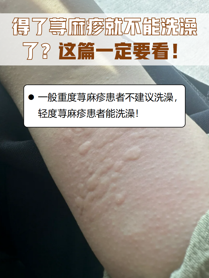 重度荨麻疹患者可能会出现全身大片风团,一般不建议洗澡,轻度荨麻疹