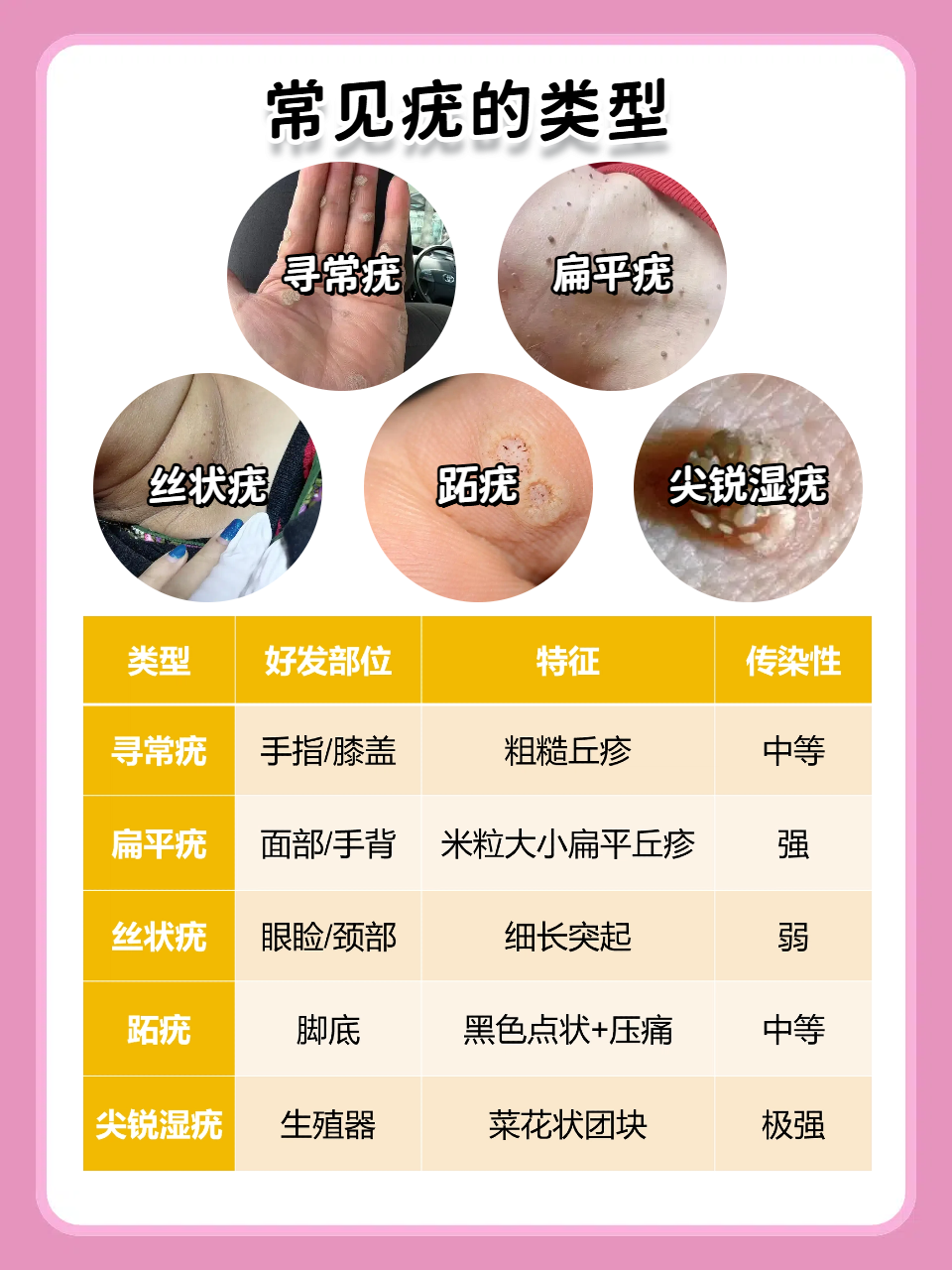 咪喹莫特乳膏治疣的原理: 激活免疫:咪喹莫特乳膏可刺激皮肤免