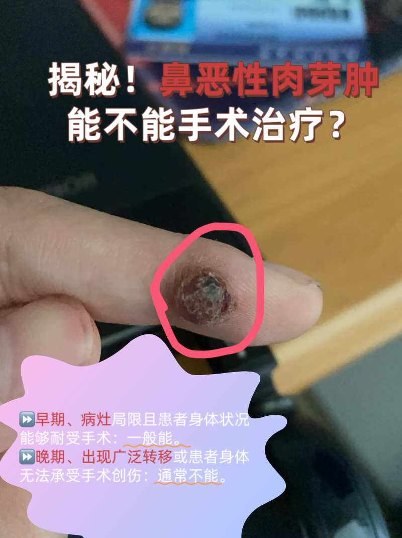 鼻腔反复溃烂流血,查出"鼻恶性肉芽肿"时,很多人第一反应是"能不能