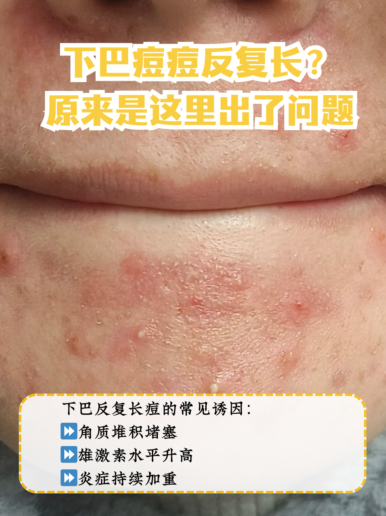 下巴长痘为什么会痒百科在线