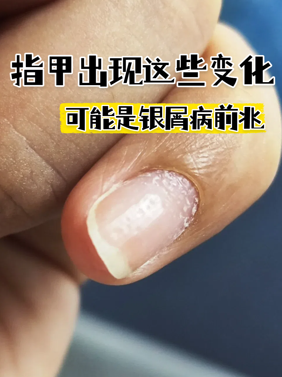 病图片初期手指甲银屑病初期图片指甲银屑病图片银屑病甲的症状图片