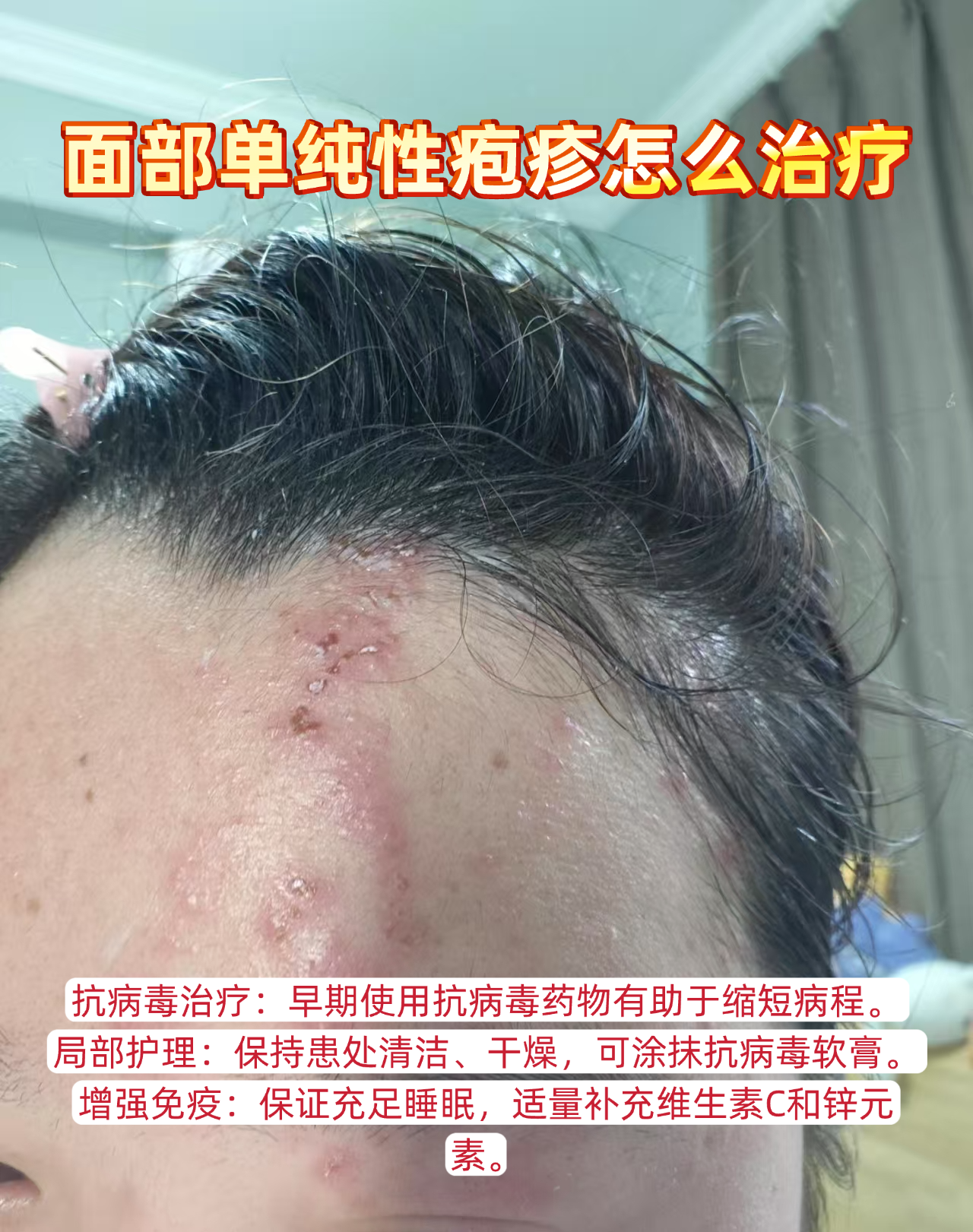 面部单纯性疱疹怎么治疗