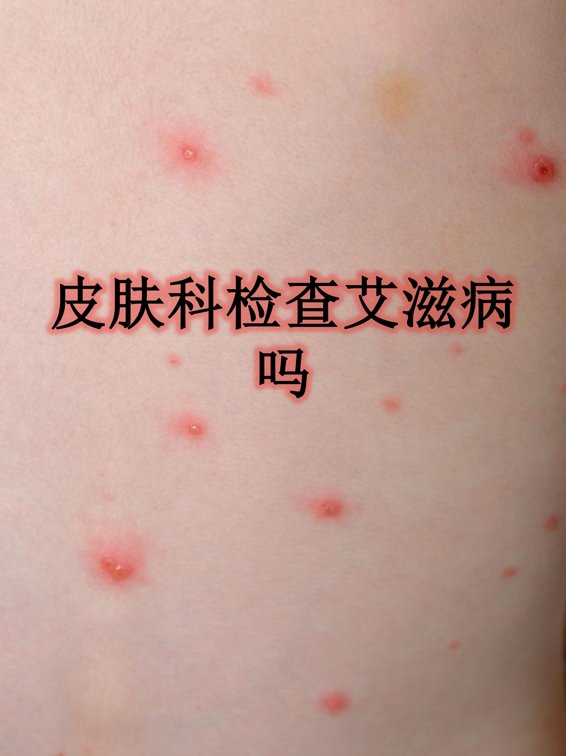 传染病医院可以查艾滋吗(传染病医院一般都有艾滋病自愿检测点)