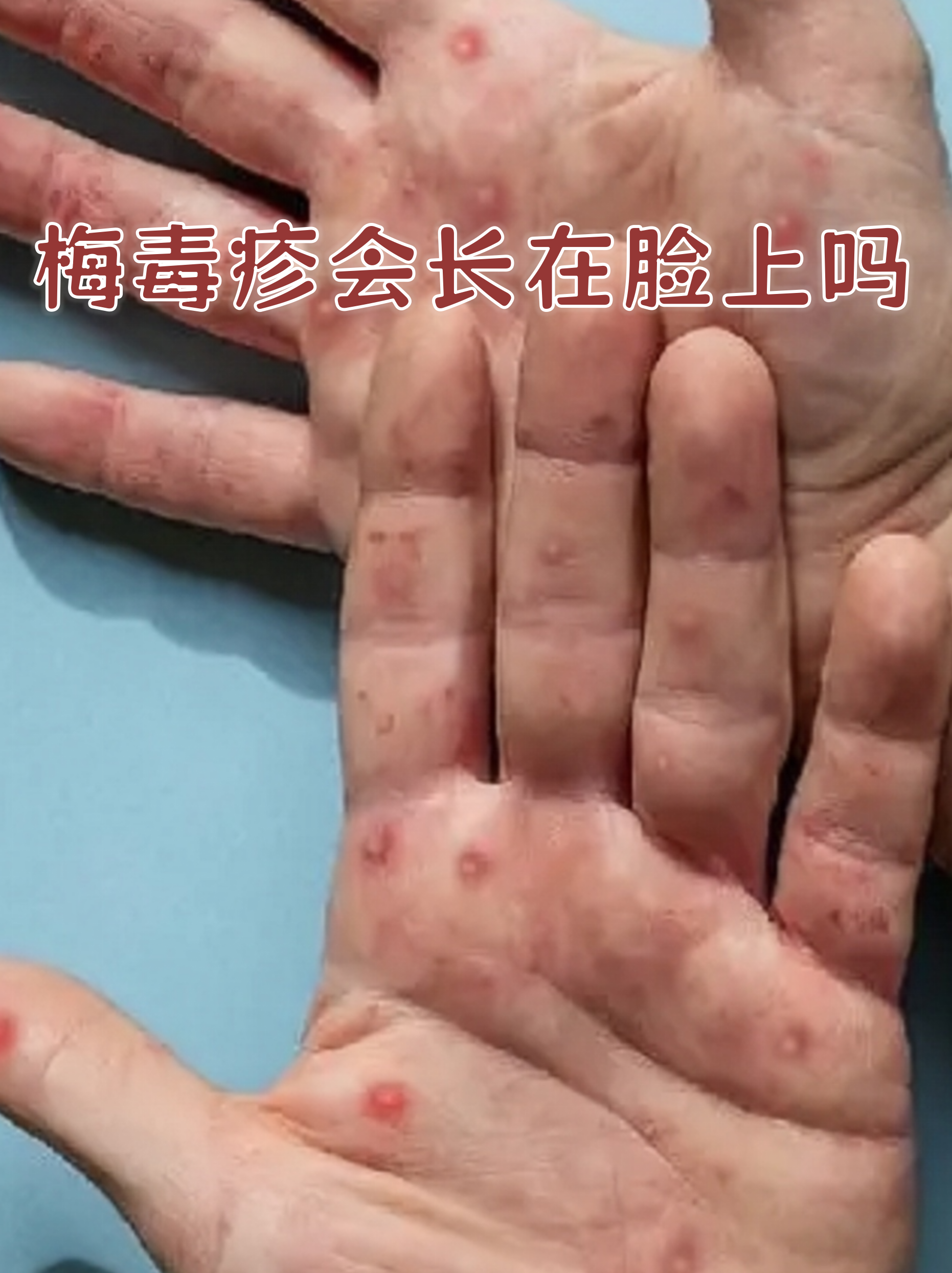 面部梅毒疹通常呈现为铜红色,边界清晰的圆形斑疹,可能伴随轻微脱屑但