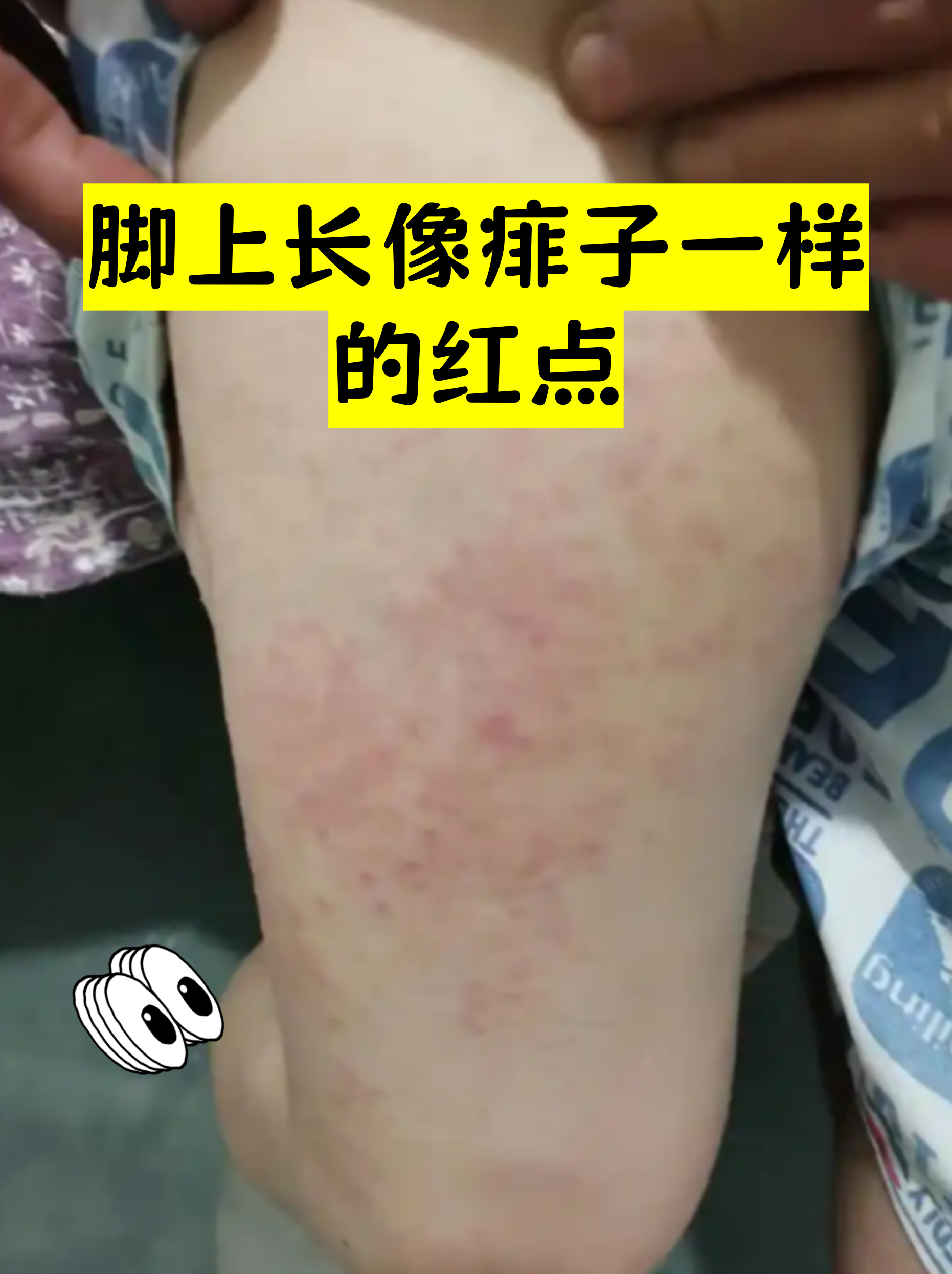 脚上长像痱子一样的红点