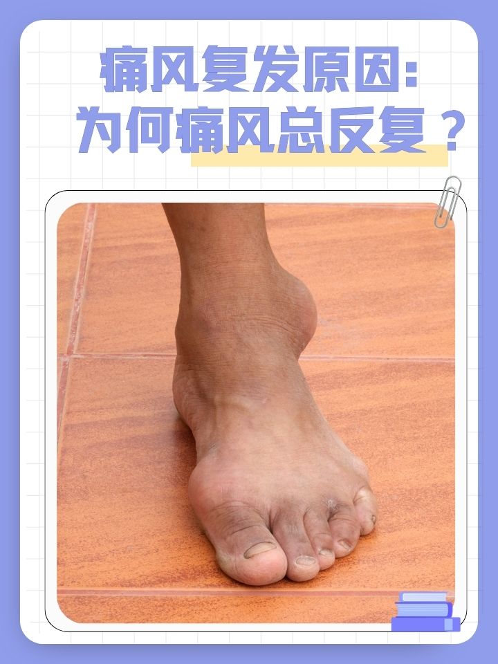 年轻人为什么会痛风 年轻人为什么会痛风