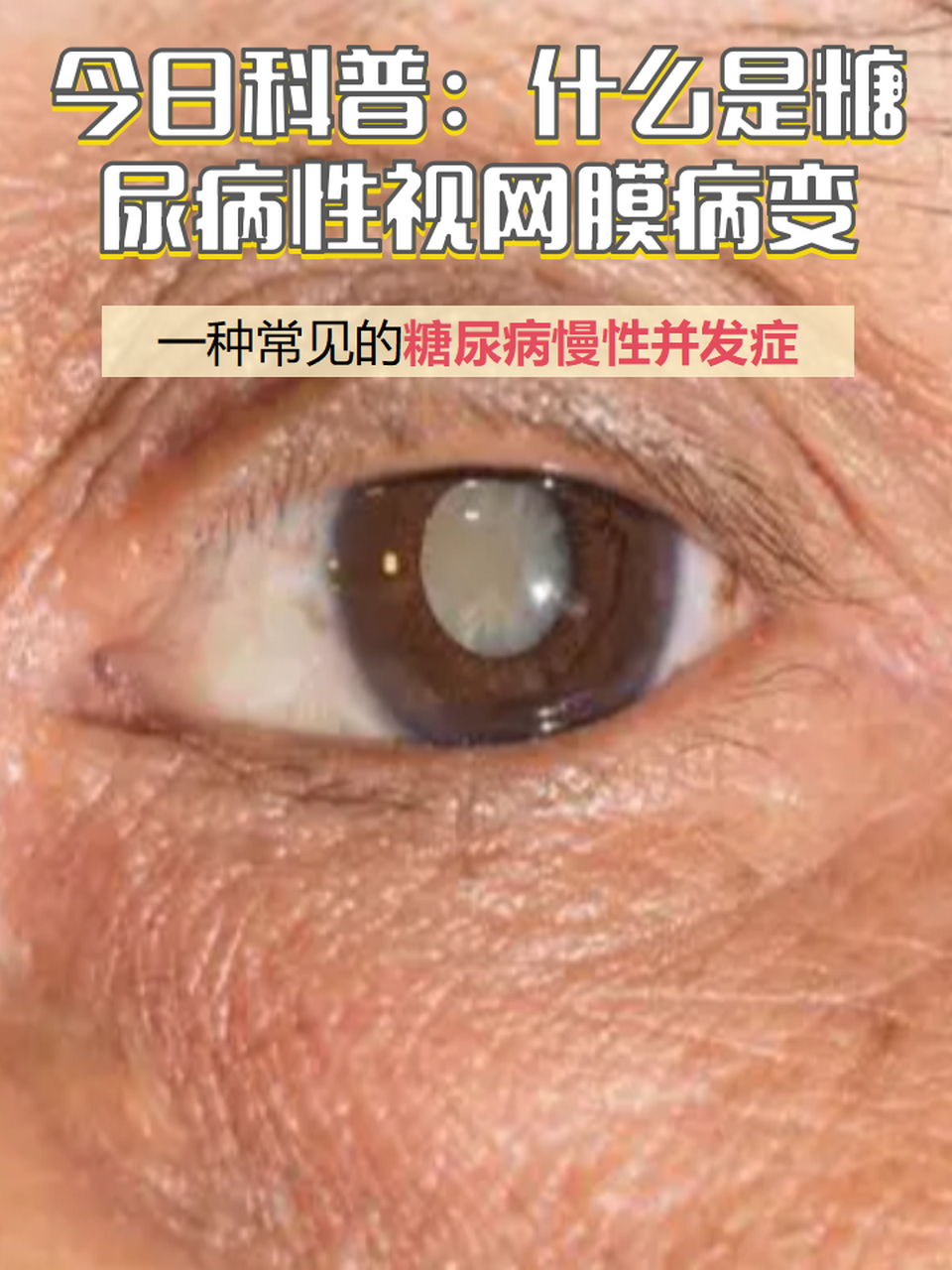 02 事实上,糖尿病性视网膜病变是一种常见的糖尿病慢性