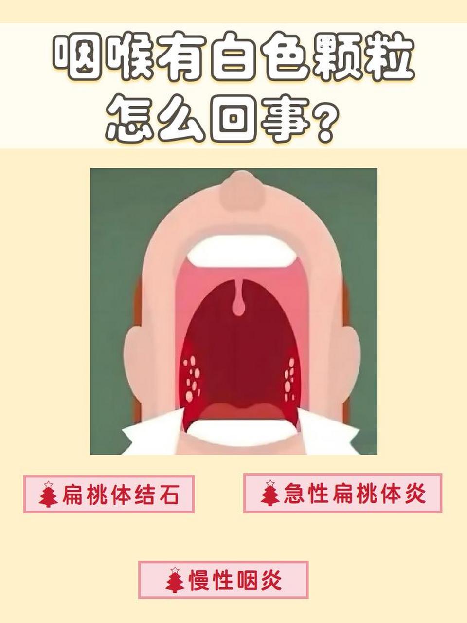 但有时候可能会发现,在咽喉处有白色的小颗粒,这到底是怎么回事呢❓
