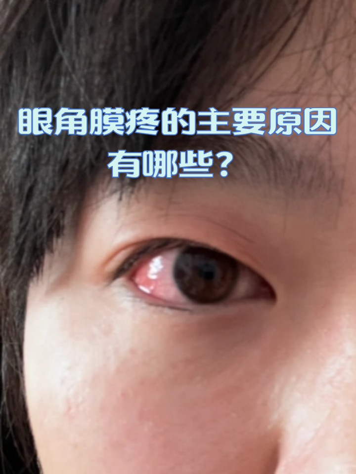眼角膜是眼睛前端的一层透明薄膜,眼角膜的感觉