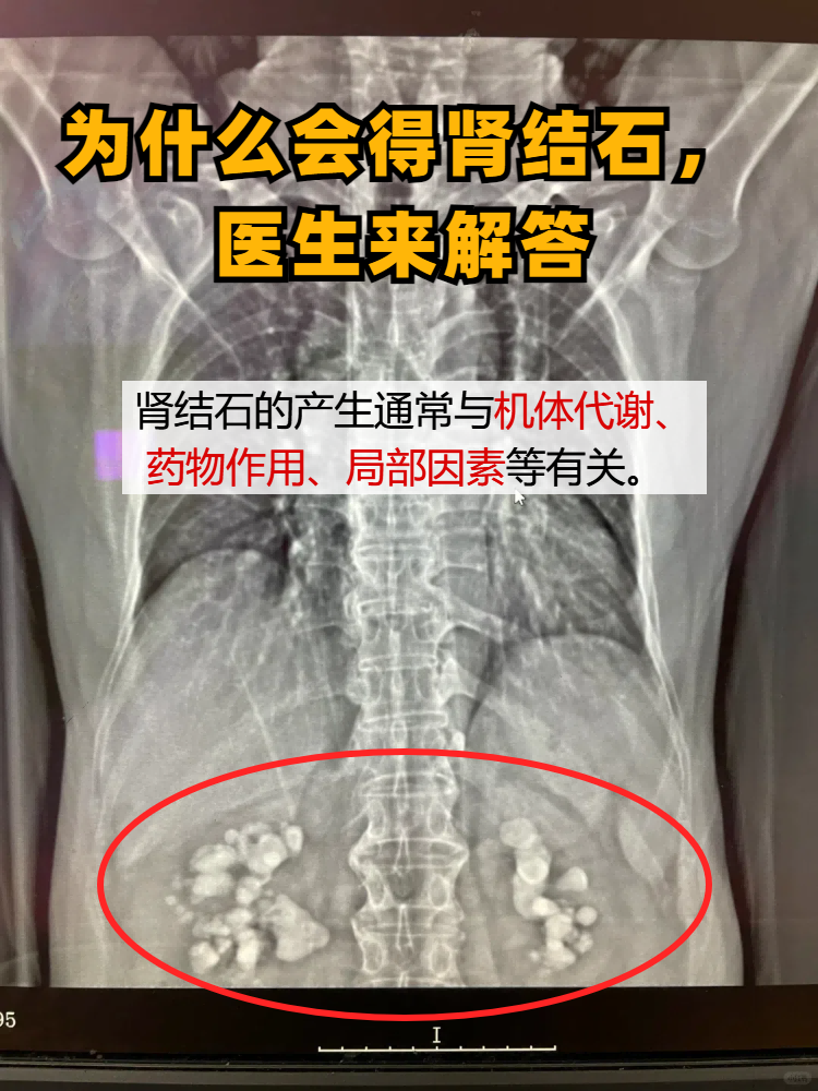 补钙为什么会结石为什么在线 补钙为什么会结石为什么在线