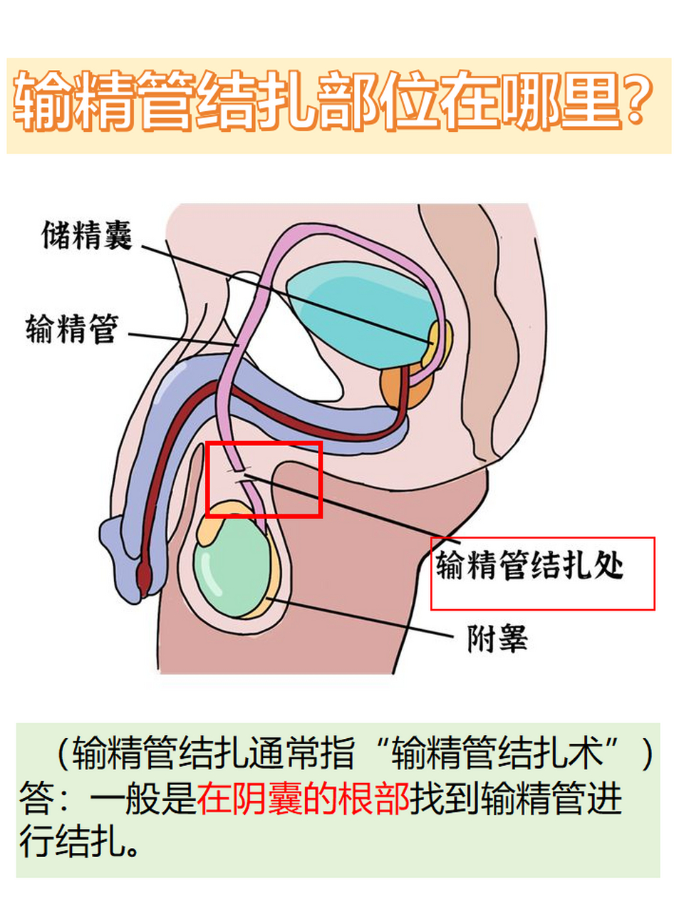 而男性结扎的手术一般叫输精管结扎术,那么结扎的部位是哪里呢71