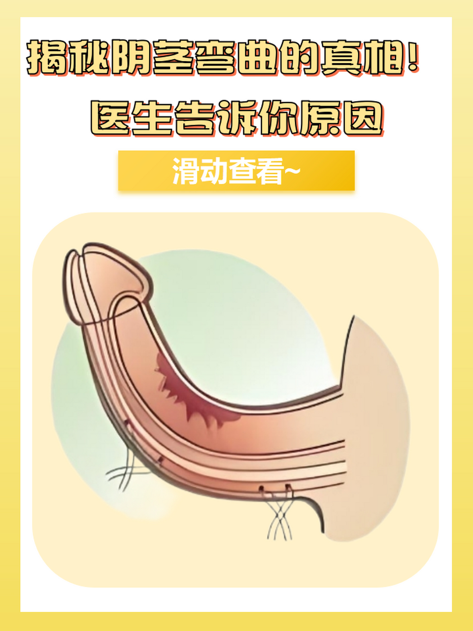 我今天就来为大家揭秘阴茎弯曲的真相,帮助大家了解并应对这一问题.