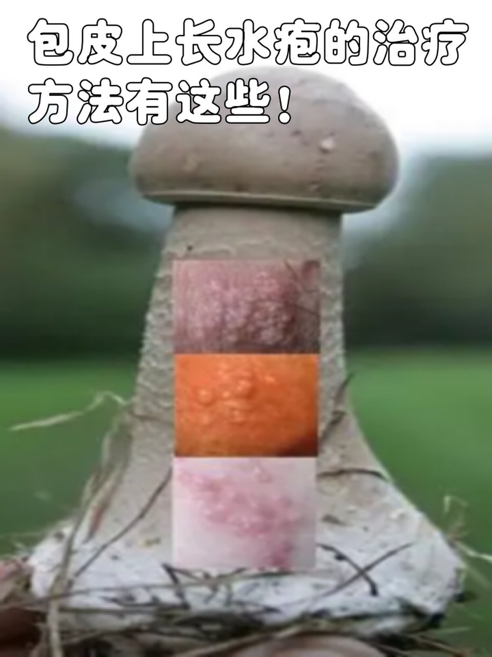 阴痉长水泡图片