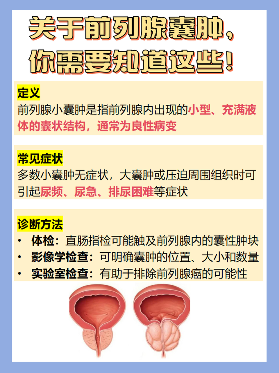 前列腺小囊肿就像是前列腺里长了个小水泡,一般是良性的,很多男性在