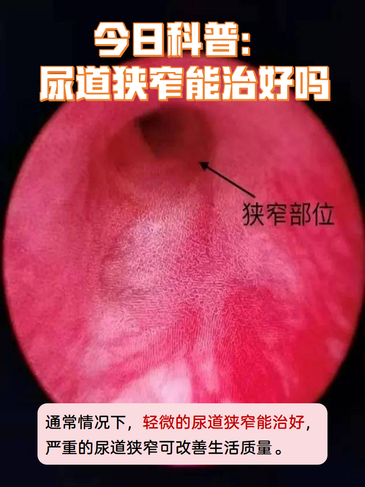 今日科普:尿道狭窄能治好吗