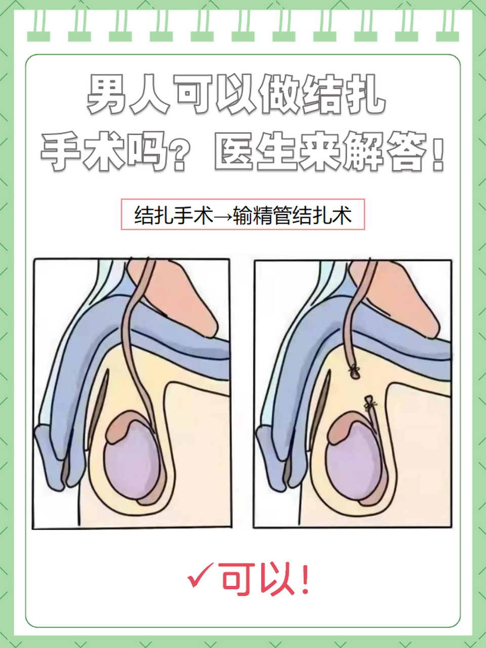 它一般指输精管结扎术,是一种通过阻断精子输出路径来达到避孕目的的