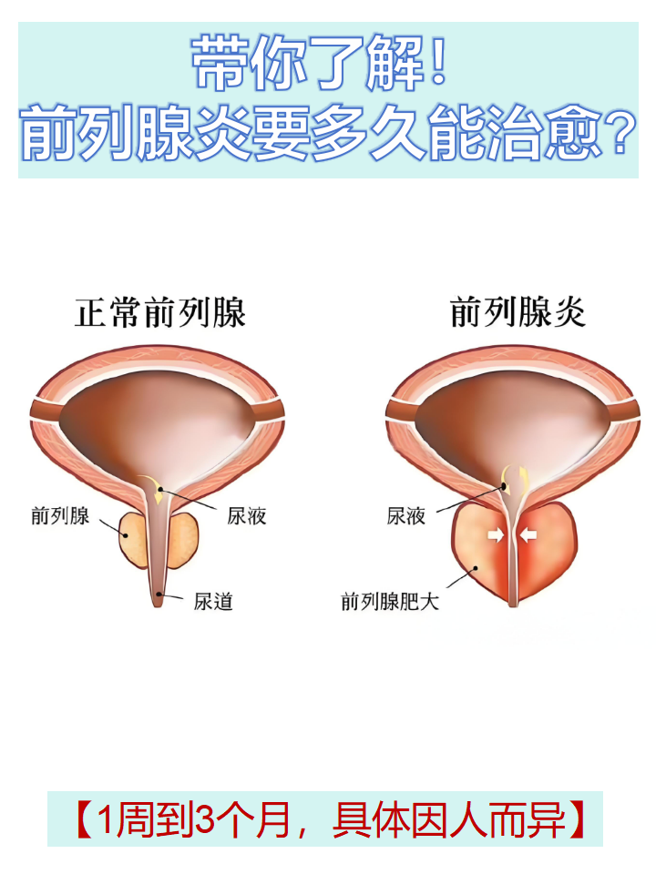 前列腺炎要多久能治愈