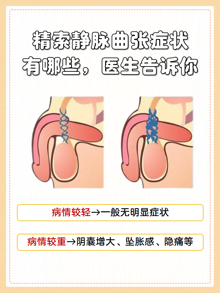 精索静脉曲张症状哪些,医生告诉你