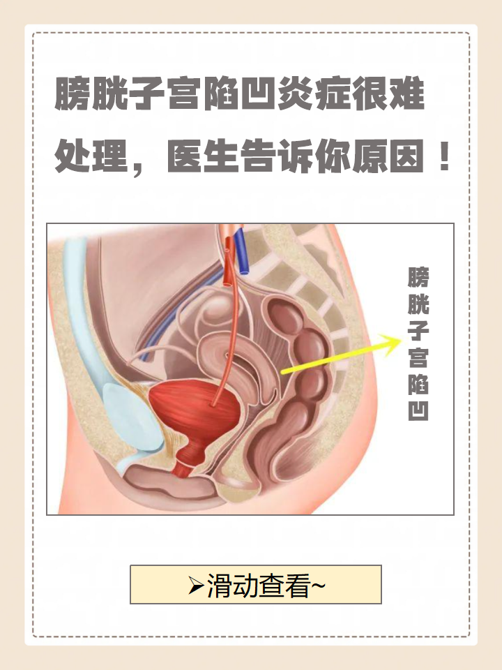 膀胱子宫陷凹炎症很难处理?医生告诉你原因!