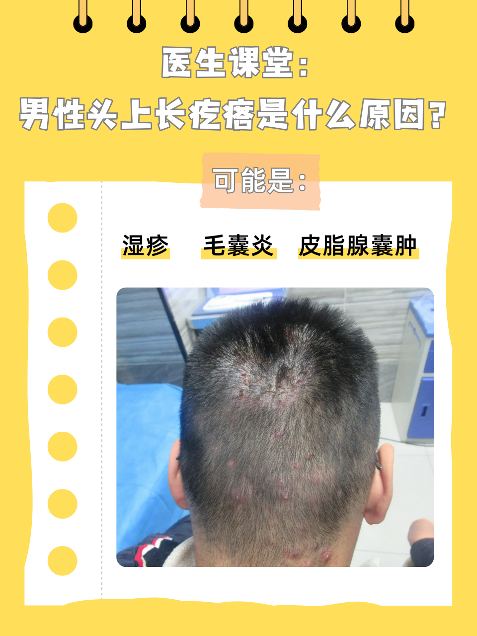 头上长红疙瘩毛囊炎怎么治疗头上长小疙瘩是怎么回事头上有疙瘩是什么