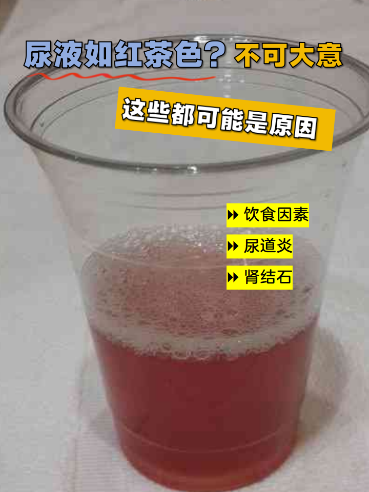 尿液如红茶色?
