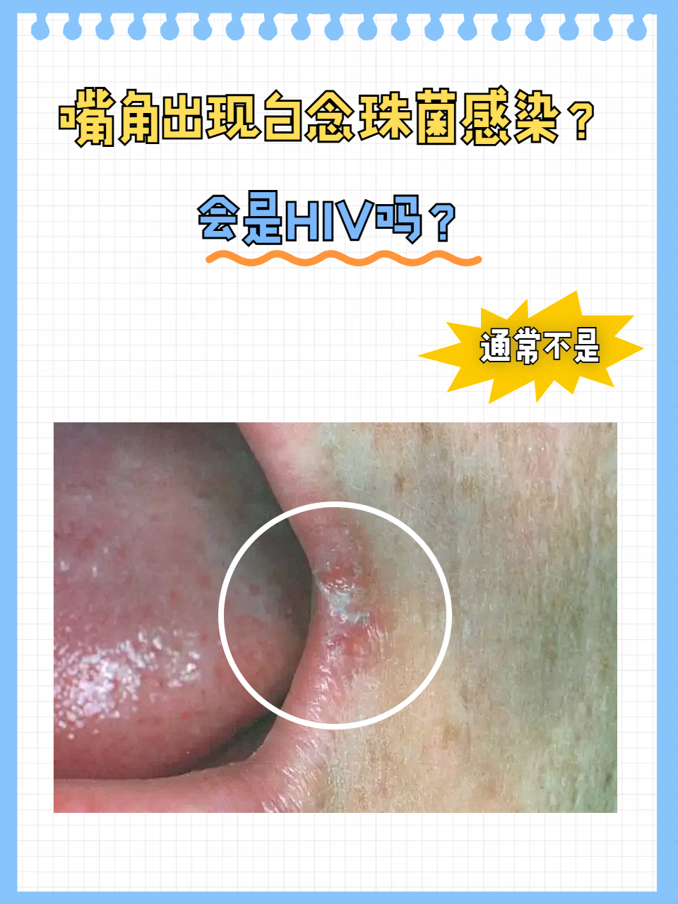 男性白色念珠菌感染图片艾滋病照片艾滋病嘴唇白色念珠菌图片女的得了