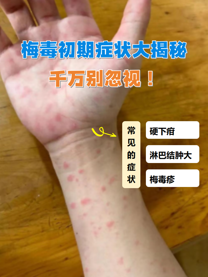 梅毒初期症状大揭秘,千万别忽视!