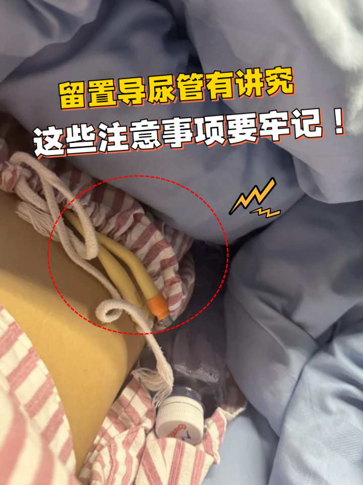 留置导尿管有讲究,这些注意事项要牢记!