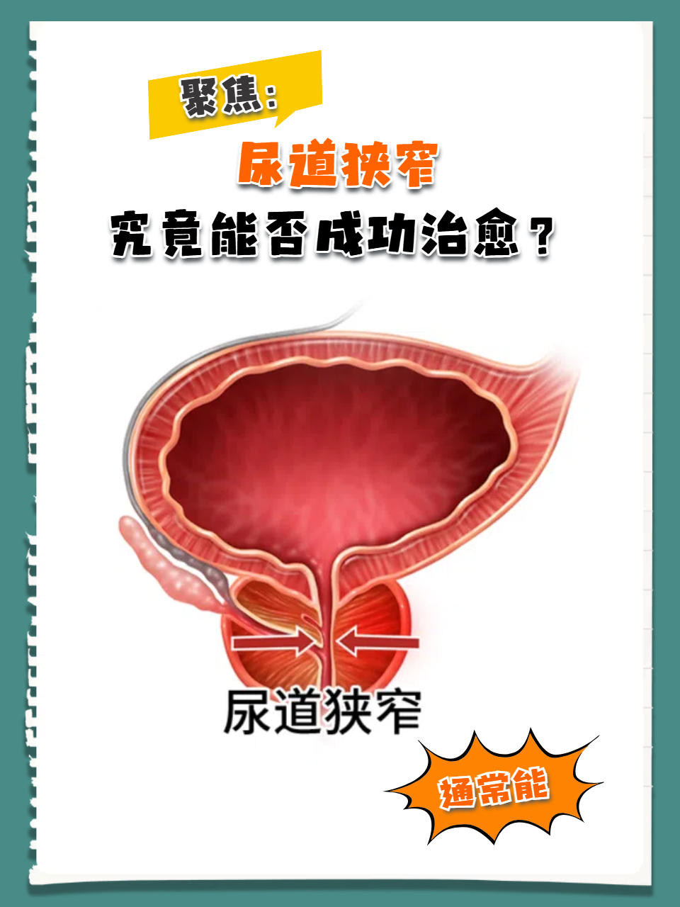 尿道狭窄是泌尿系统的常见问题,很多患者都关心是否可以成功治愈