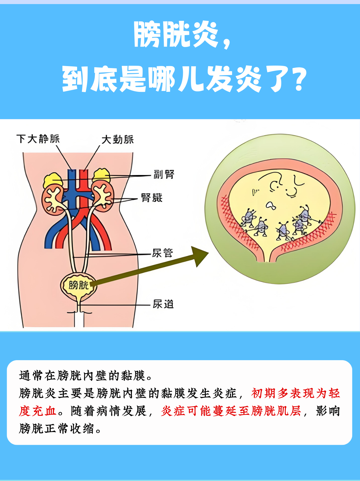 什么症状膀胱炎是什么症状表现膀胱痛在哪个部位图解膀胱炎图片膀胱炎