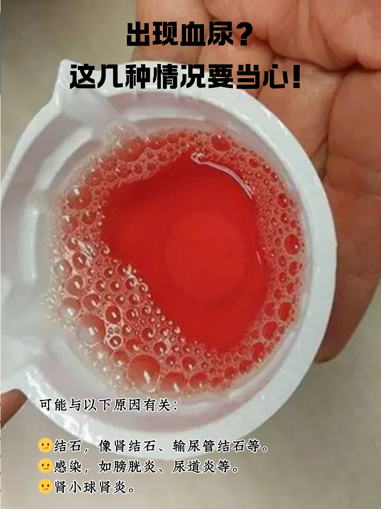 当发现尿液中出现血液,也就是血尿,很多人都会感到惊慌