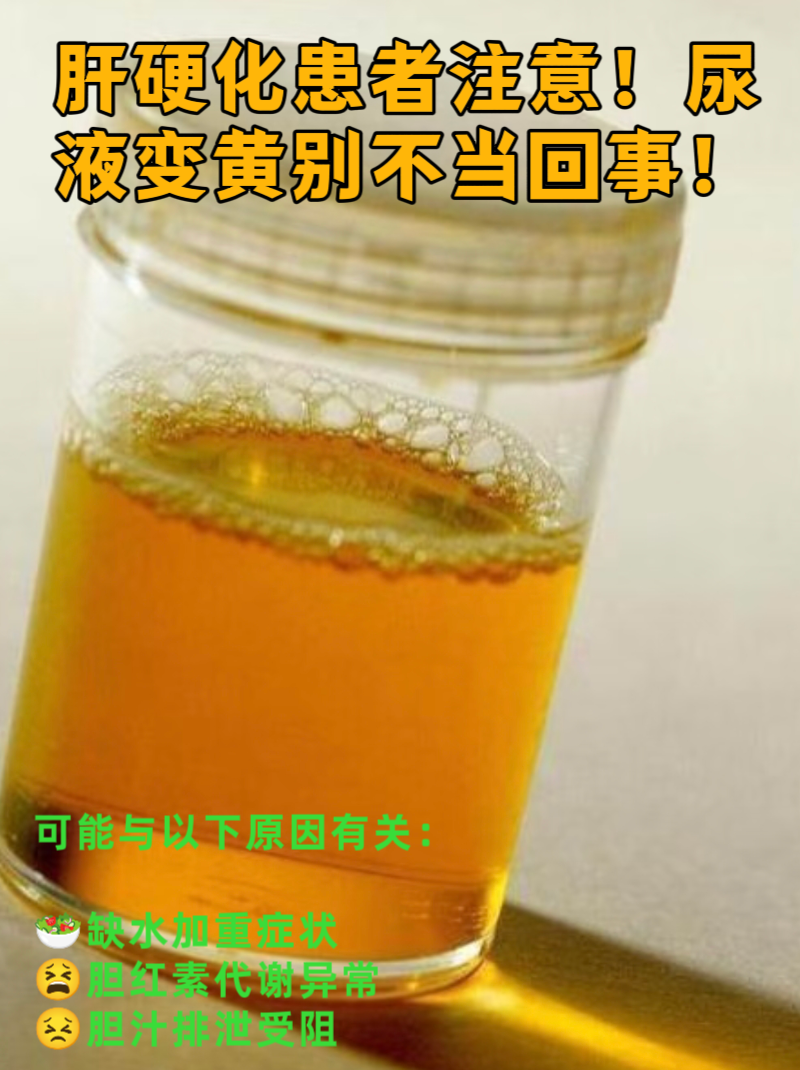 尿为什么很黄 尿为什么很黄
