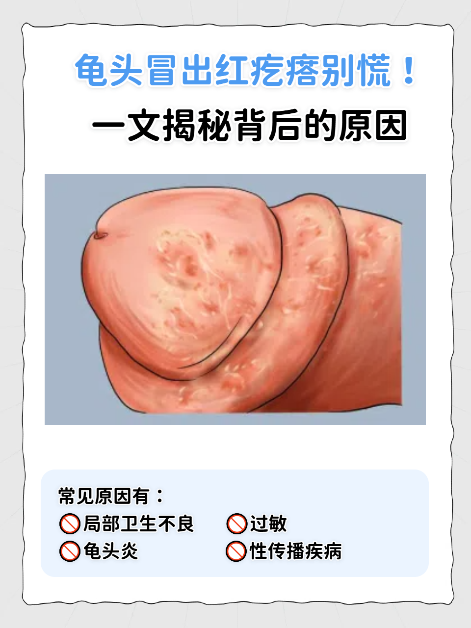 发现龟头长红疙瘩,不少人瞬间慌了神:是过敏