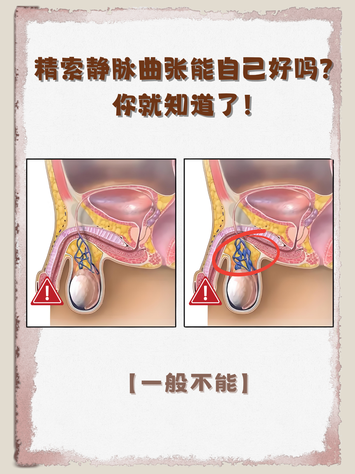 睾丸静脉曲张精索静脉曲张外表图片精索静脉曲张有什么症状和危害精索