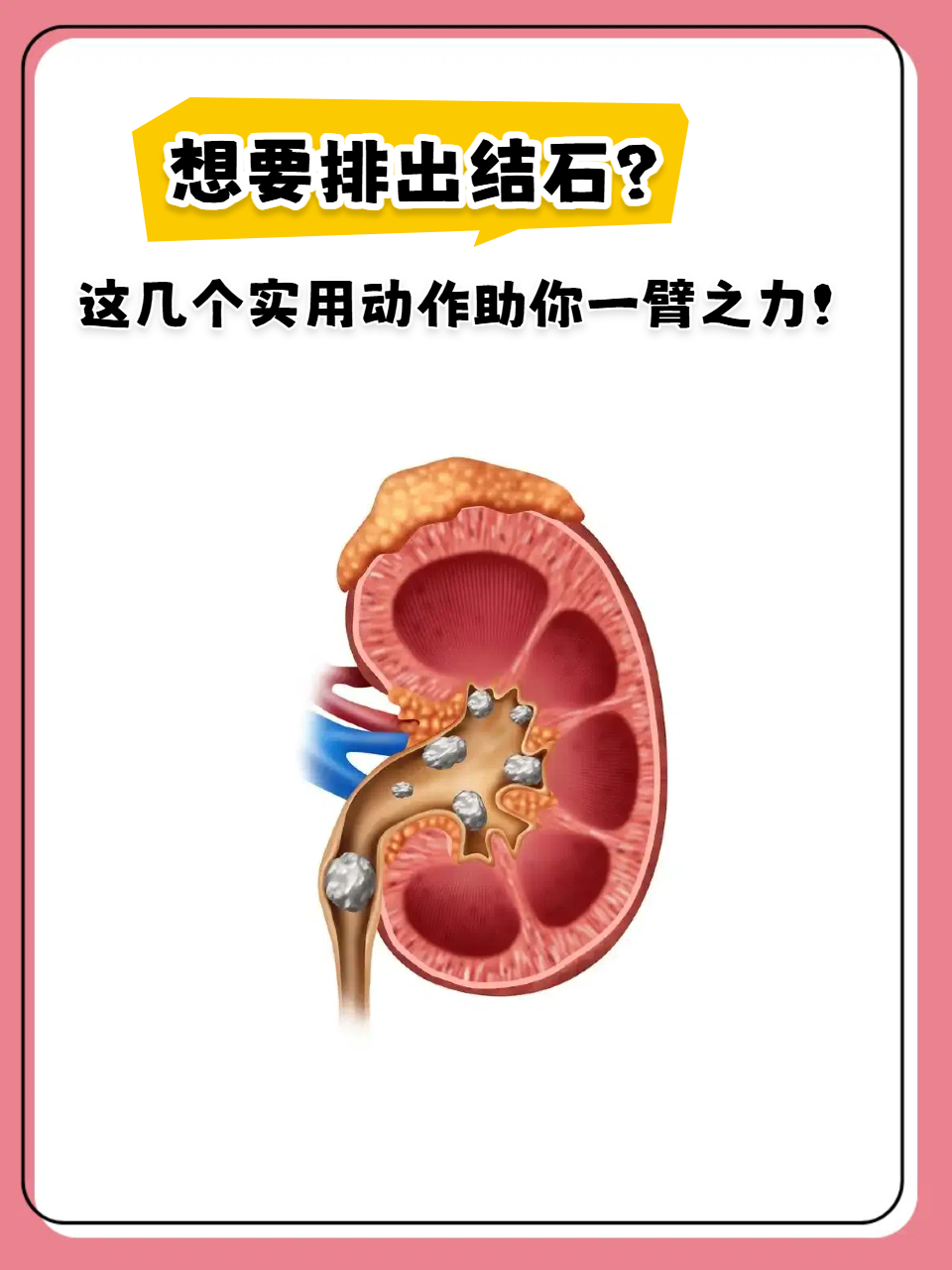 查出体内有结石,除了吃药,手术,通过运动也能辅助排石