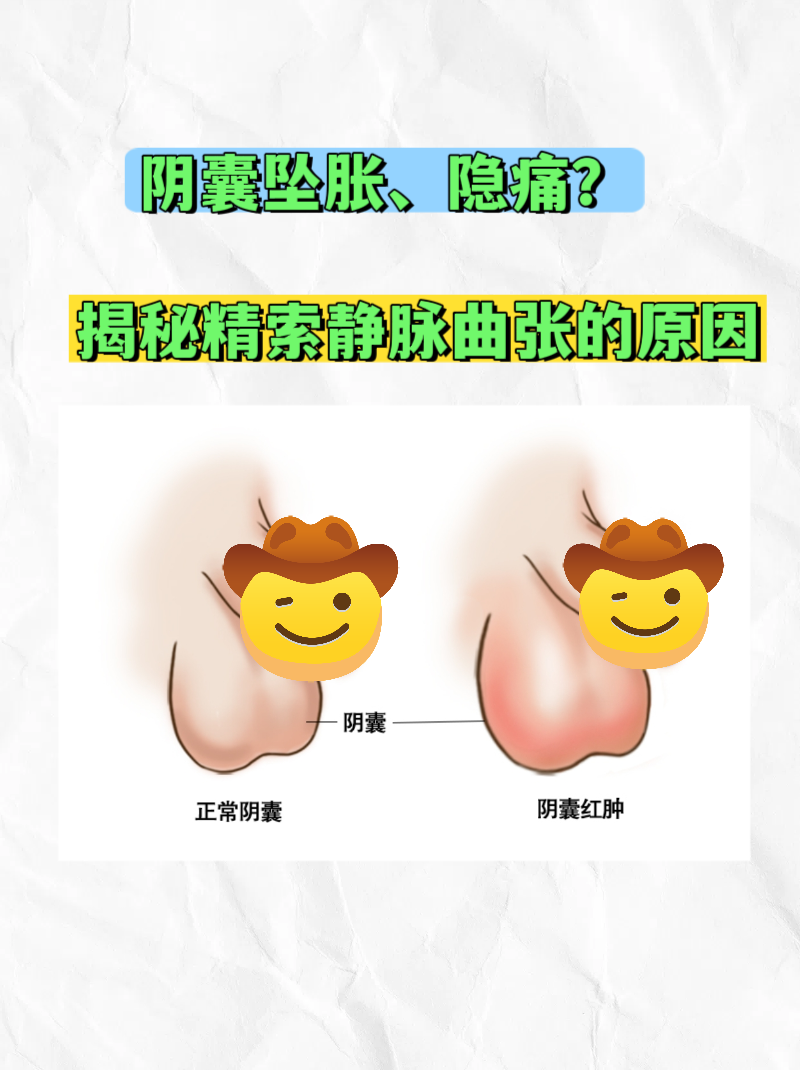 揭秘精索静脉曲张的原因