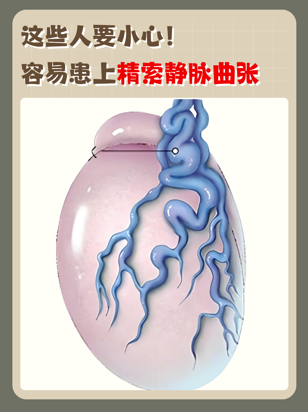 精索静脉曲张并非偶然发生,特定人群更易"中招"