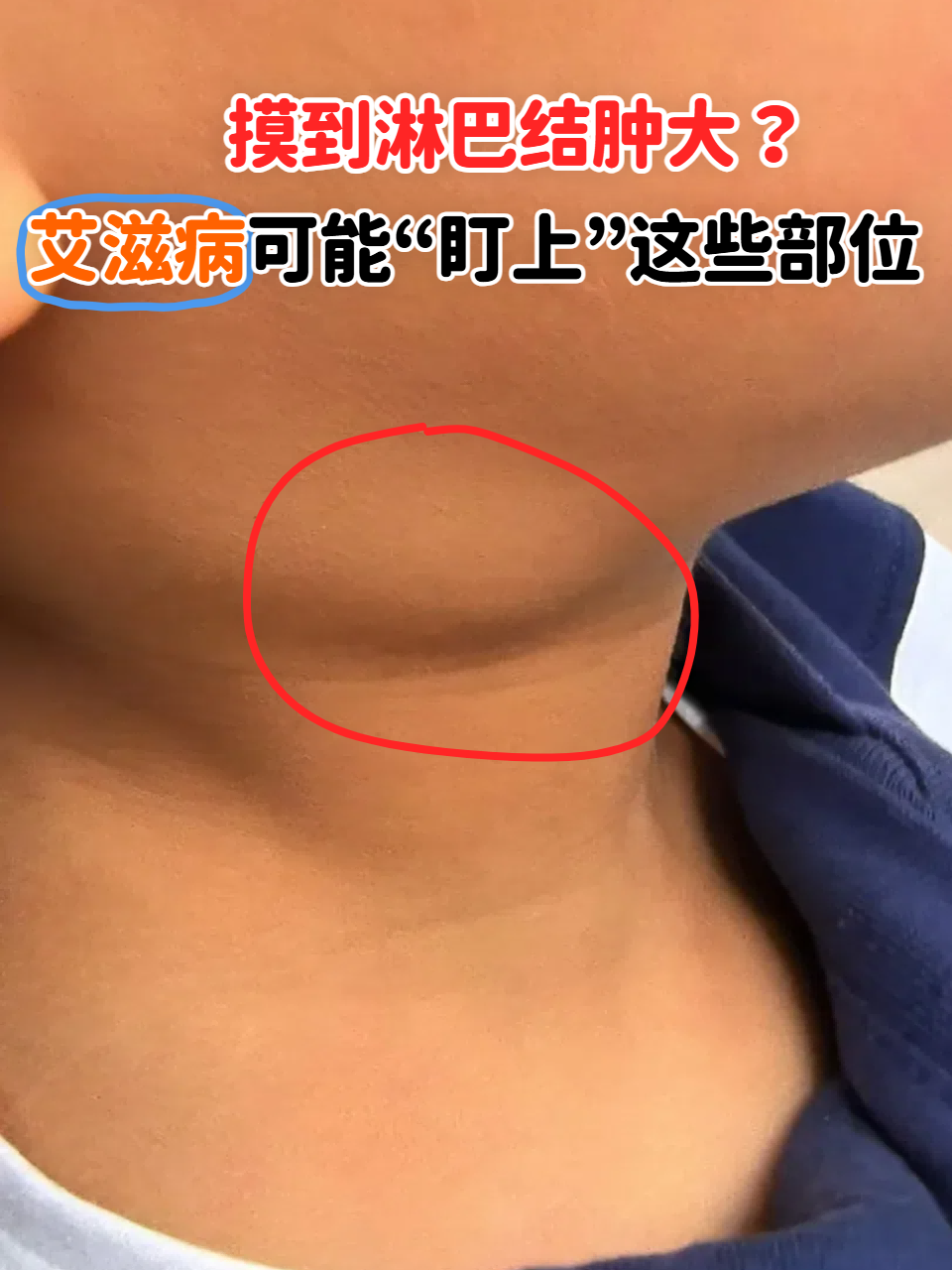这些淋巴结肿大的信号,可能与艾滋病有关!