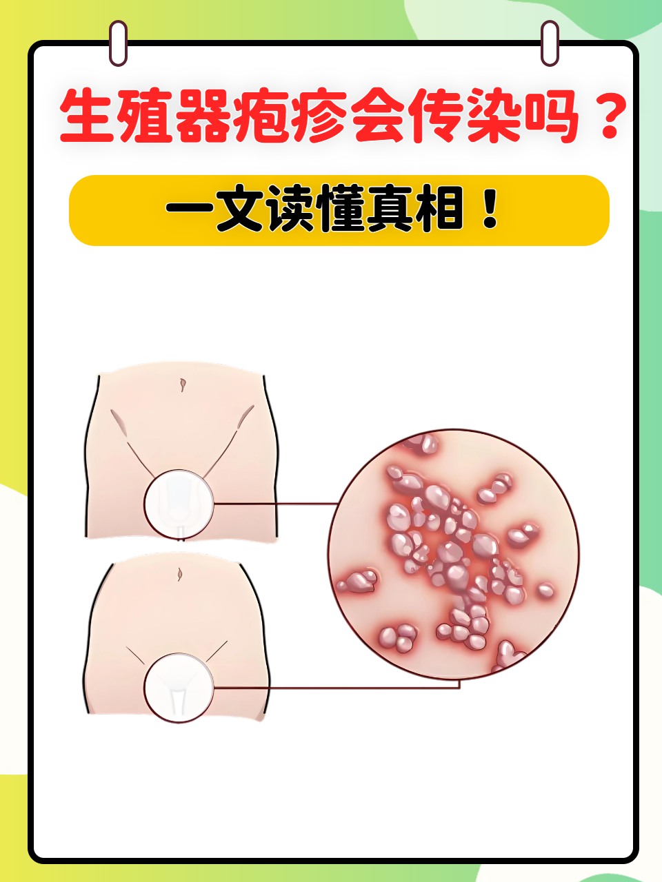 生殖器疱疹会传染吗?一文读懂真相!