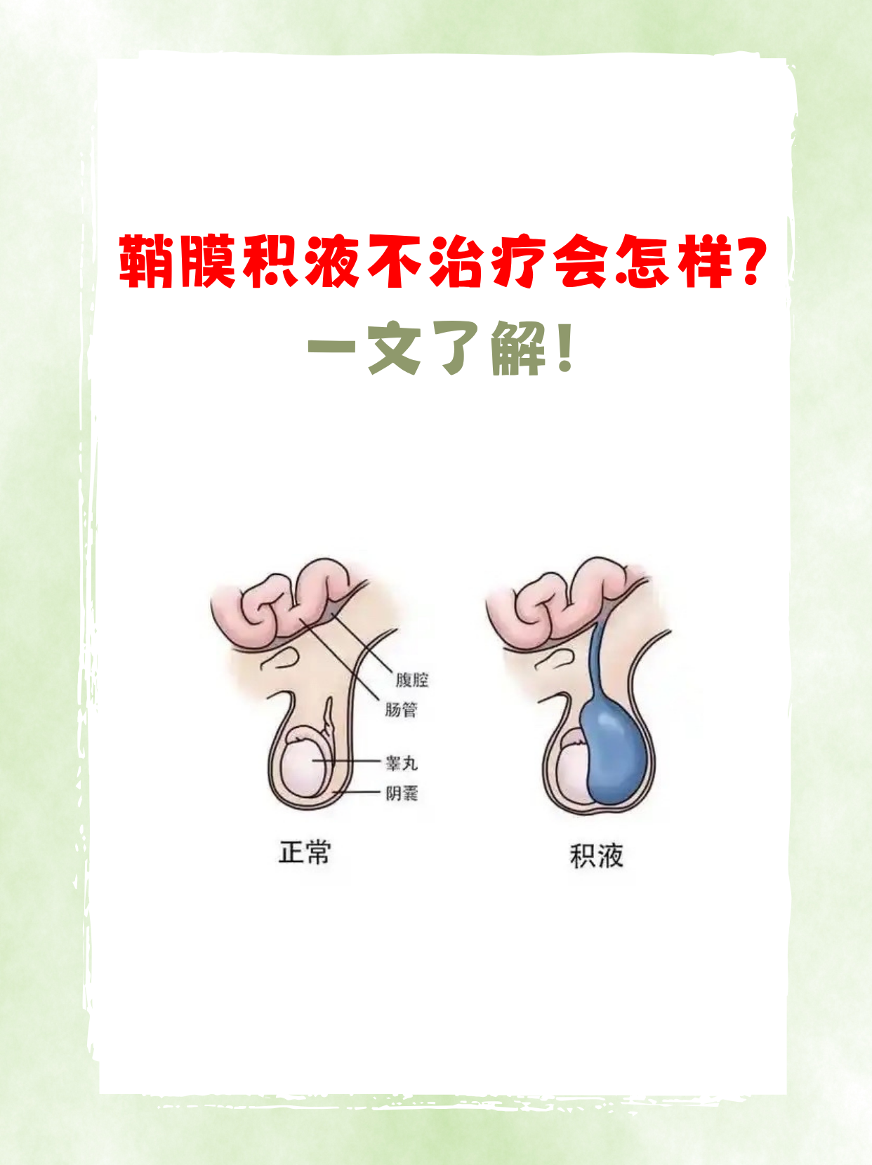 鞘膜积液不治疗会怎样?一文了解!