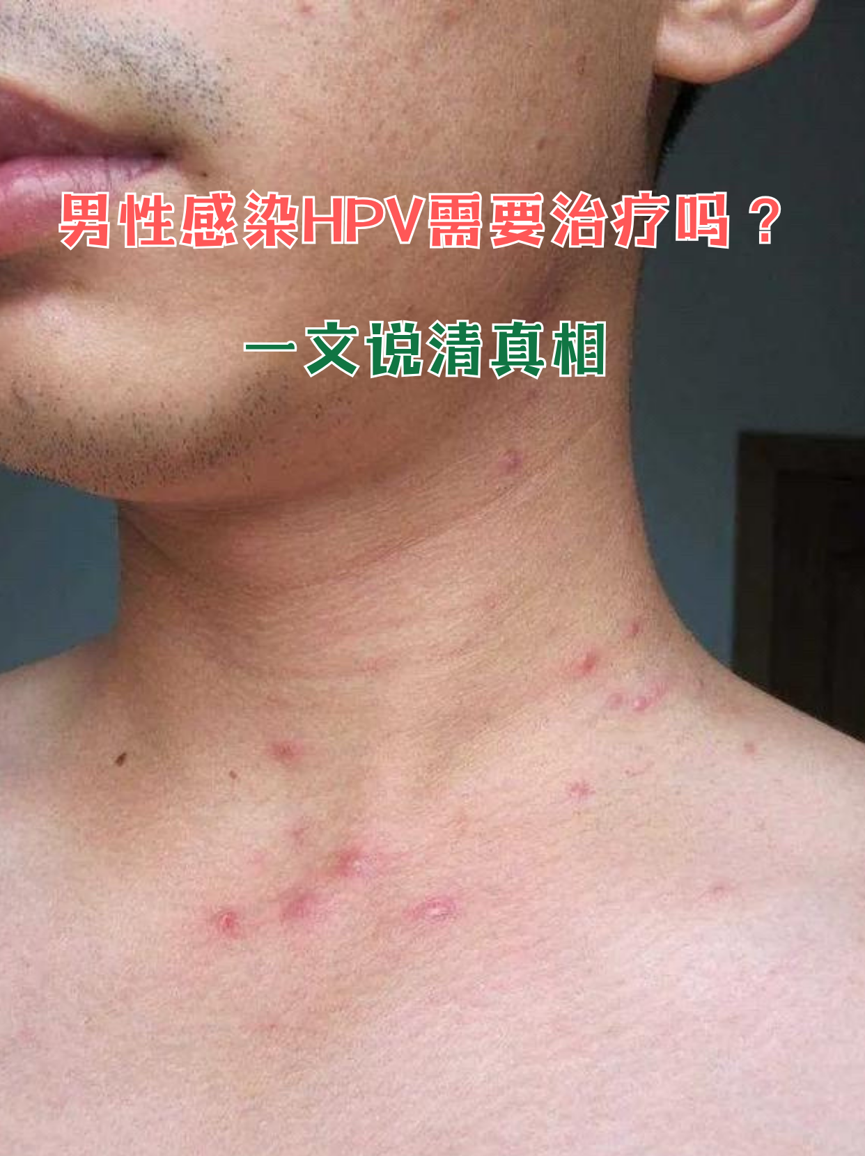 私处莫名长疙瘩,伴侣查出hpv,男性感染后该怎么办?
